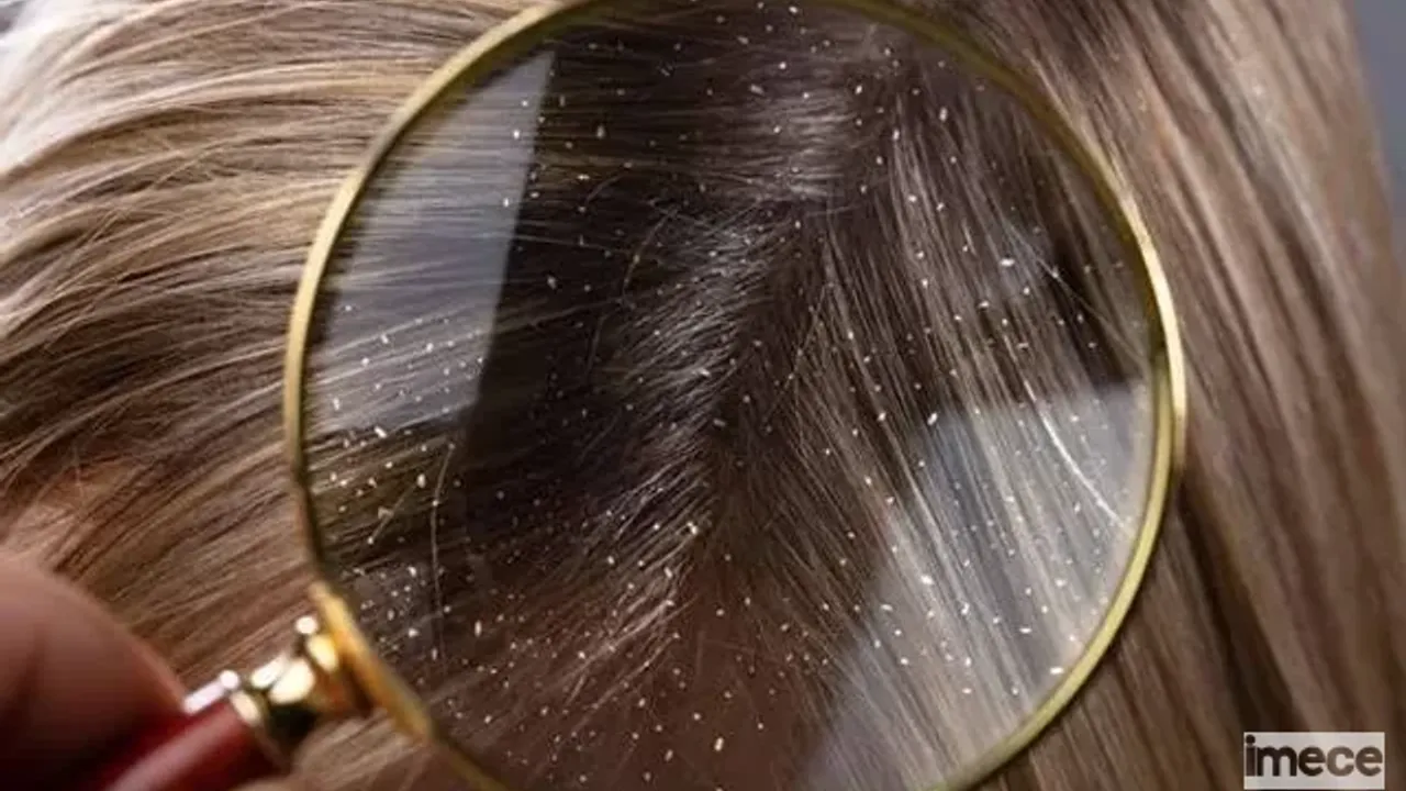 Saçınızı Kepeklerden Tek Gecede Arındıracak Doğal Yöntem