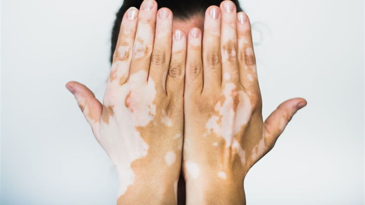 Stres ve Travmalar Vitiligo Hastalığını Tetikliyor