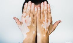 Stres ve Travmalar Vitiligo Hastalığını Tetikliyor