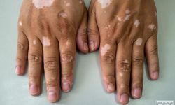 Vitiligo Nedir?