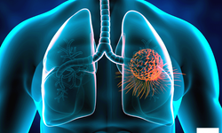 Prof. Dr. Fındıkçıoğlu: Yılda 30 Bin Kişiye Akciğer Kanseri Teşhisi Konuluyor