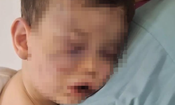 2 Yaşındaki Bebek Annesinin Sevgilisi Tarafından Darp Edildi